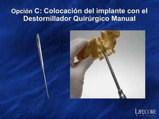 Opción  A: Colocación de Implante con Pieza de Mano    Asiente el Adaptador de Pieza de Mano sobre el Dispositivo de Montaje 