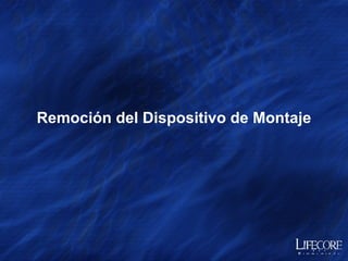 Opción  A: Colocación con Pieza de Mano  Programe el Motor Quirúrgico a  20 RPM 
