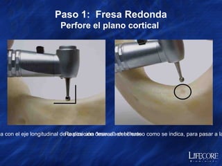   Paso 1:  Fresa Redonda  Perfore el plano cortical  Alinee la fresa con el eje longitudinal de la posición deseada del diente  Realice una “marca” en el hueso como se indica, para pasar a la siguiente fresa 