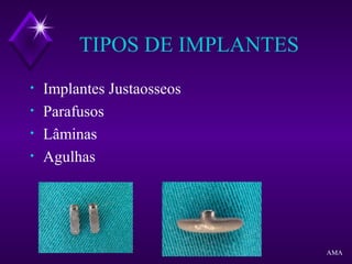 TIPOS DE IMPLANTES
• Implantes Justaosseos
• Parafusos
• Lâminas
• Agulhas
AMA
 