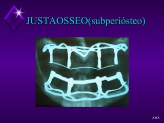 JUSTAOSSEO(subperiósteo)JUSTAOSSEO(subperiósteo)
AMA
 