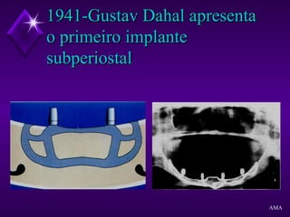 1941-Gustav Dahal apresenta1941-Gustav Dahal apresenta
o primeiro implanteo primeiro implante
subperiostalsubperiostal
AMA
 