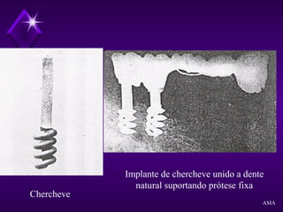 Chercheve
Implante de chercheve unido a dente
natural suportando prótese fixa
AMA
 