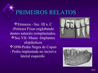 PRIMEIROS RELATOS
Etruscos - Sec. III a .C
-Próteses Fixas englobando
dentes naturais reimplantados.
Sec.VII- Maias -Implantes
aloplásticos
1890-Pedra Negra de Copan
- Pedra implantada no incisivo
lateral esquerdo
AMA
 