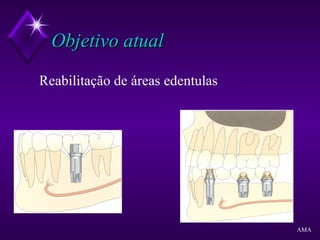 Objetivo atualObjetivo atual
Reabilitação de áreas edentulas
AMA
 