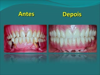 Antes Depois 