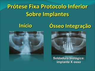 Início Prótese Fixa Protocolo Inferior Sobre Implantes Ósseo Integração Soldadura biológica: implante X osso 