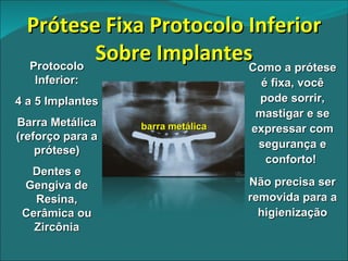 barra metálica Protocolo Inferior: 4 a 5 Implantes Barra Metálica (reforço para a prótese) Dentes e Gengiva de Resina, Cerâmica ou Zircônia Como a prótese é fixa, você pode sorrir, mastigar e se expressar com segurança e conforto!  Não precisa ser removida para a higienização Prótese Fixa Protocolo Inferior Sobre Implantes 