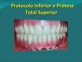Protocolo Inferior e Prótese Total Superior 