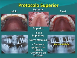 Protocolo Superior Início Final Superior - 6 a 8 Implantes Barra Metálica - Dentes e gengiva de Resina, Cerâmica ou Zircônia Durante barra metálica 