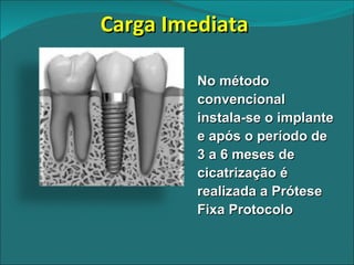 Carga Imediata  No método convencional instala-se o implante e após o período de 3 a 6 meses de cicatrização é realizada a Prótese Fixa Protocolo 