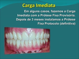 Carga Imediata  Em alguns casos, fazemos a Carga Imediata com a Prótese Fixa Provisória. Depois de 3 meses instalamos a Prótese Fixa Protocolo (definitiva) 
