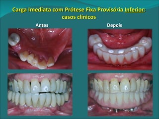Carga Imediata com Prótese Fixa Provisória  Inferior : casos clínicos Antes Depois 