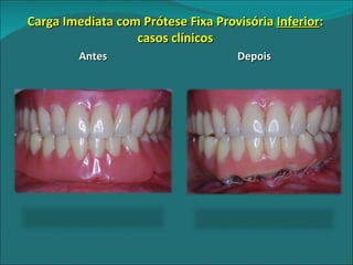 Carga Imediata com Prótese Fixa Provisória  Inferior : casos clínicos Antes Depois 