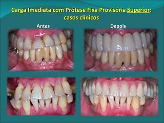 Carga Imediata com Prótese Fixa Provisória  Superior : casos clínicos Antes Depois 