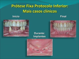 Prótese Fixa Protocolo Inferior: Mais casos clínicos Início Final Durante: Implantes 