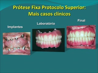 Implantes Laboratório Final Prótese Fixa Protocolo Superior: Mais casos clínicos 