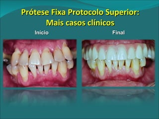 Prótese Fixa Protocolo Superior: Mais casos clínicos Início Final 