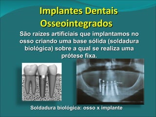 Implantes Dentais Osseointegrados  Soldadura biológica: osso x implante  São raízes artificiais que implantamos no osso criando uma base sólida (soldadura biológica) sobre a qual se realiza uma prótese fixa. 