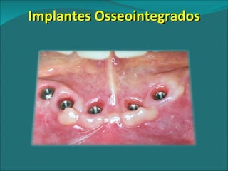 Implantes Osseointegrados 