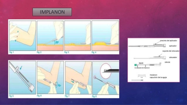 Implantes subdermico
