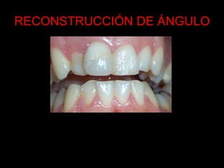 RECONSTRUCCIÓN DE ÁNGULO
 
