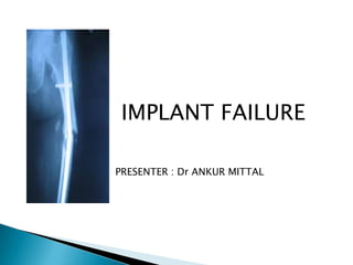 IMPLANT FAILURE

PRESENTER : Dr ANKUR MITTAL
 