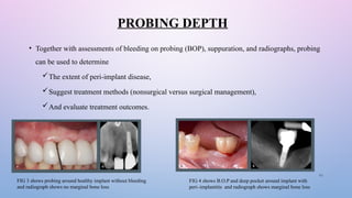 Probing Deep Implant failure & its management (Final).pptx