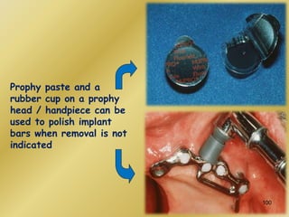 Prophy paste and a
rubber cup on a prophy
head / handpiece can be
used to polish implant
bars when removal is not
indicated
100
 