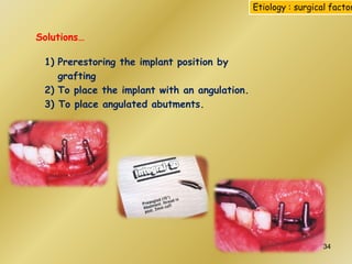 1) Prerestoring the implant position by
grafting
2) To place the implant with an angulation.
3) To place angulated abutments.
Solutions…
Etiology : surgical factor
34
 