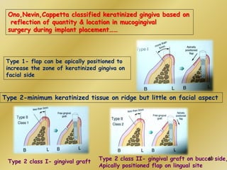 Ono,Nevin,Cappetta classified keratinized gingiva based on
reflection of quantity & location in mucogingival
surgery during implant placement……
Type 1- flap can be apically positioned to
increase the zone of keratinized gingiva on
facial side
Type 2-minimum keratinized tissue on ridge but little on facial aspect
Type 2 class I- gingival graft Type 2 class II- gingival graft on buccal side,
Apically positioned flap on lingual site
69
 