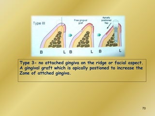 Type 3- no attached gingiva on the ridge or facial aspect.
A gingival graft which is apically postioned to increase the
Zone of attched gingiva.
70
 