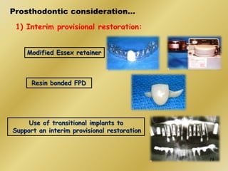 Prosthodontic consideration…
1) Interim provisional restoration:
Resin bonded FPD
Use of transitional implants to
Support an interim provisional restoration
Modified Essex retainer
74
 
