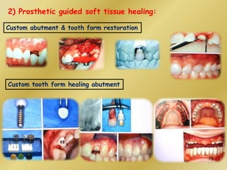 2) Prosthetic guided soft tissue healing:
Custom abutment & tooth form restoration
Custom tooth form healing abutment
75
 
