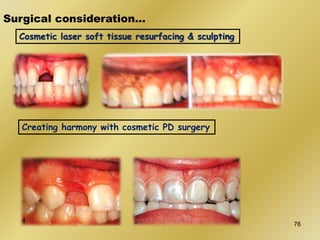 Surgical consideration…
Cosmetic laser soft tissue resurfacing & sculpting
Creating harmony with cosmetic PD surgery
76
 
