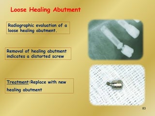 Radiographic evaluation of a
loose healing abutment.
Removal of healing abutment
indicates a distorted screw
Treatment:Replace with new
healing abutment
Loose Healing Abutment
83
 