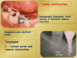 Loose restoration…
Radiographic Evaluation: Small
opening at abutment-implant
interface
Small
opening
Diagnosis:Loose abutment
screw
Treatment:
1 - Loosen screw and
remove restoration
86
 