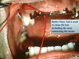 Butler Floss Aid is used
to clean the bar
including the area
contacting the tissue.
96
 