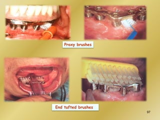 End tufted brushes
Proxy brushes
97
 