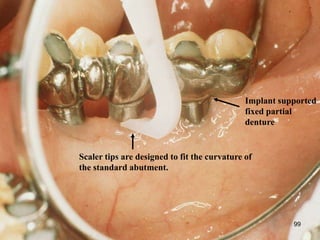Implant supported
fixed partial
denture
Scaler tips are designed to fit the curvature of
the standard abutment.
99
 