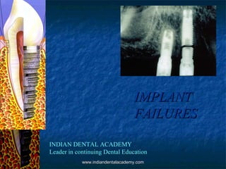 IMPLANTIMPLANT
FAILURESFAILURES
INDIAN DENTAL ACADEMY
Leader in continuing Dental Education
www.indiandentalacademy.comwww.indiandentalacademy.com
 