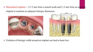  Mesiodistal implants - 1.5–2 mm from a natural tooth and 2–3 mm from an adjacent
implant to maintain an adequate biologic dimension.
 Violation of biologic width around an implant can lead to bone loss.
 