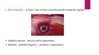  Buccolingually - at least 2 mm of bone circumferentially around the implant.
 Implant exposure - abscess and/or suppuration.
 Implants - palatally/lingually - prosthetic compensation
 