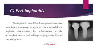 C) Peri-implantitis
Periimplantitis was defined as a plaque associated
pathologic condition occurring in the tissue around dental
implants, characterized by inflammation in the
periimplant mucosa and subsequent progressive loss of
supporting bone.
- Carranza
 