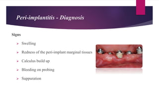 Signs
 Swelling
 Redness of the peri-implant marginal tissues
 Calculus build up
 Bleeding on probing
 Suppuration
Peri-implantitis - Diagnosis
 