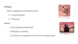 Probing :
Blunt, straight plastic periodontal probe
 Automated probe
 TPS probe
Assess:
a) Peri-implant probing depth
b) Bleeding on probing
c) Exudation and suppuration from the peri-implant space.
 