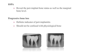 IOPA
 Reveal the peri-implant bone status as well as the marginal
bone level.
Progressive bone loss
 Definite indicator of peri-implantitis
 Should not be confused with physiological bone
 