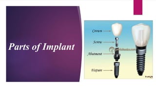 Parts of Implant
 