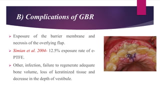 B) Complications of GBR
 Exposure of the barrier membrane and
necrosis of the overlying flap.
 Simian et al. 2004- 12.5% exposure rate of e-
PTFE.
 Other, infection, failure to regenerate adequate
bone volume, loss of keratinized tissue and
decrease in the depth of vestibule.
 