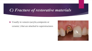 C) Fracture of restorative materials
 Usually in veneers (acrylic,composite or
ceramic ) that are attached to superstructures
 